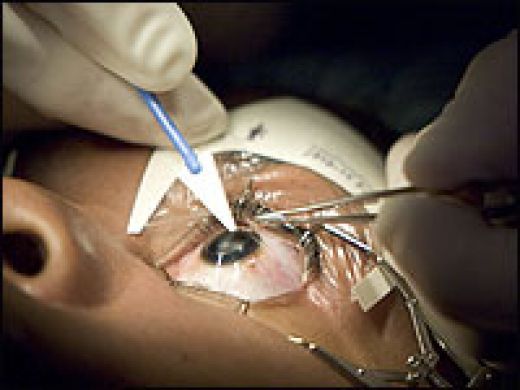 How Do You Know What To Expect From Laser Eye Surgery?