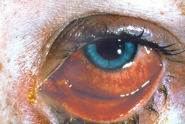 pink eye. While pinkeye can be disturbing because it may